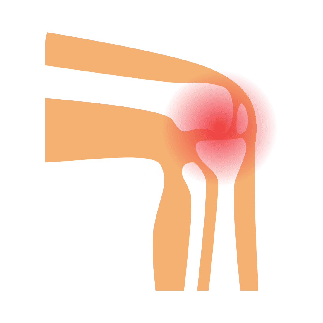 Artritis reumatoid