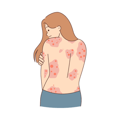 Psoriasis