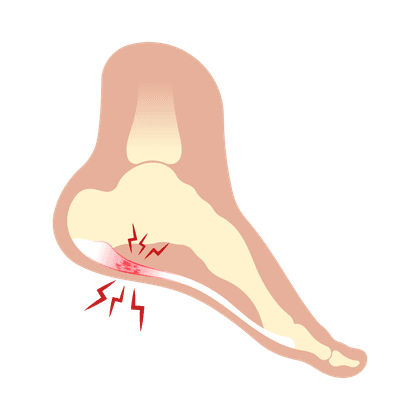 Heel spur (osteophyte)