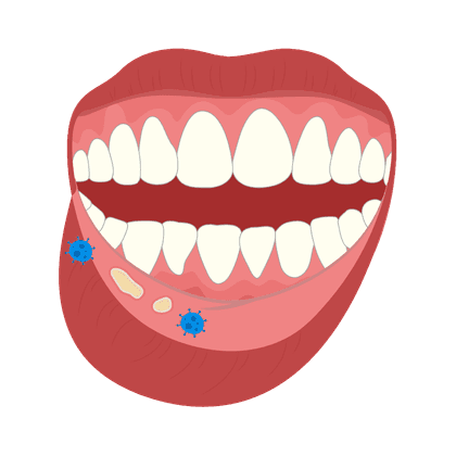 Stomatitis