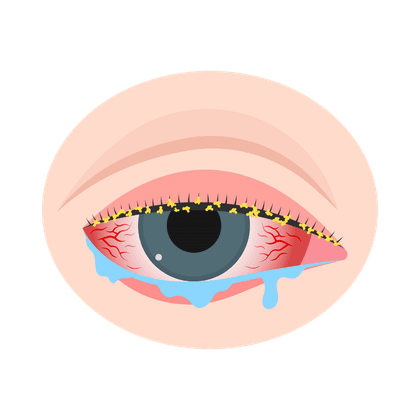 Conjunctivitis