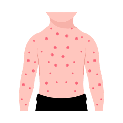 Chickenpox (varicella)